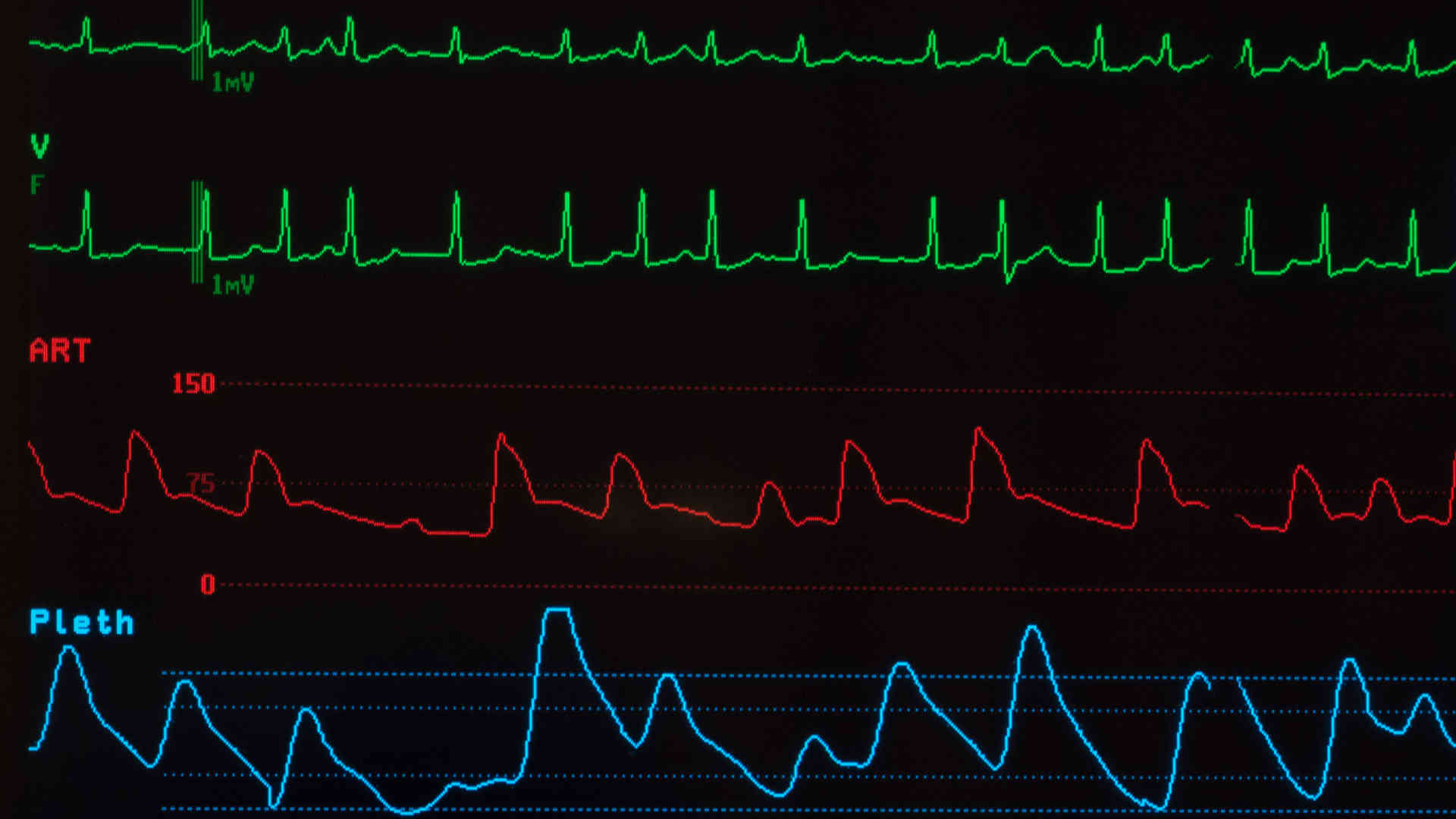 Atrial fibrillation on a monitor