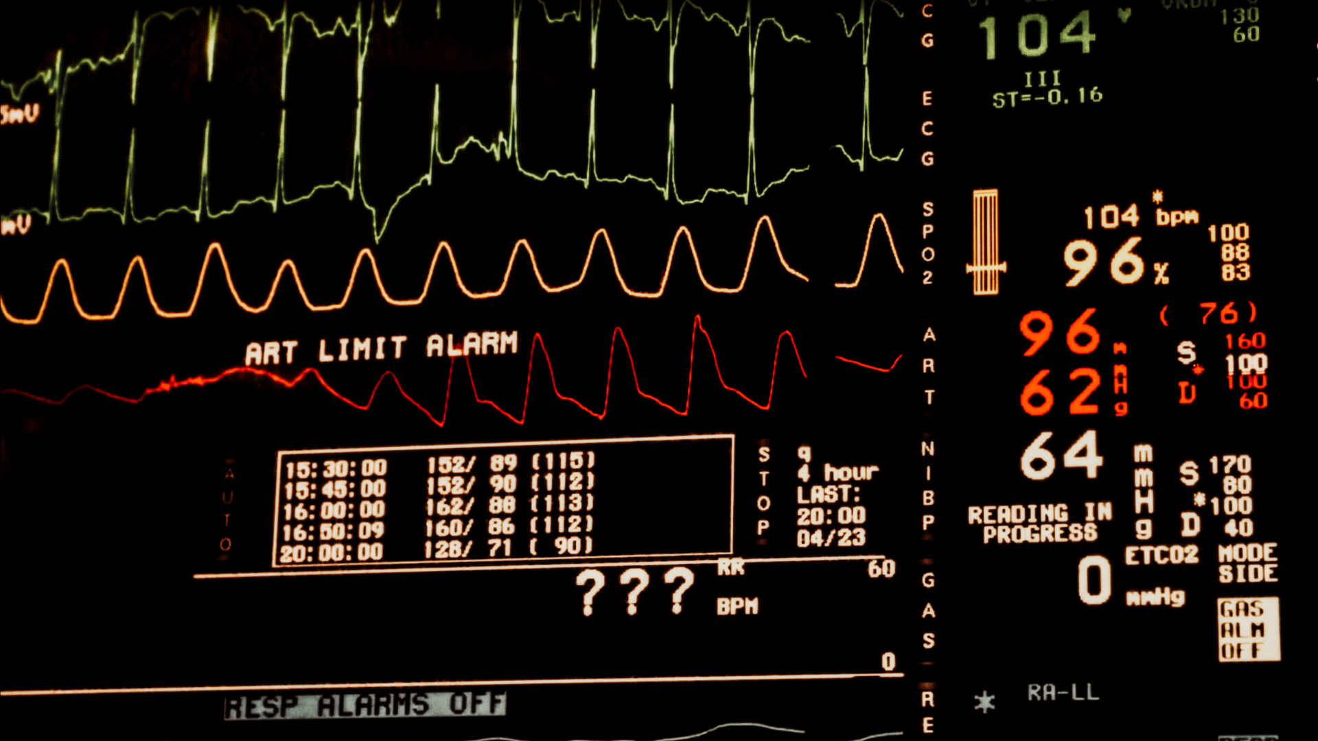 Ventilated paediatric patient in the PICU