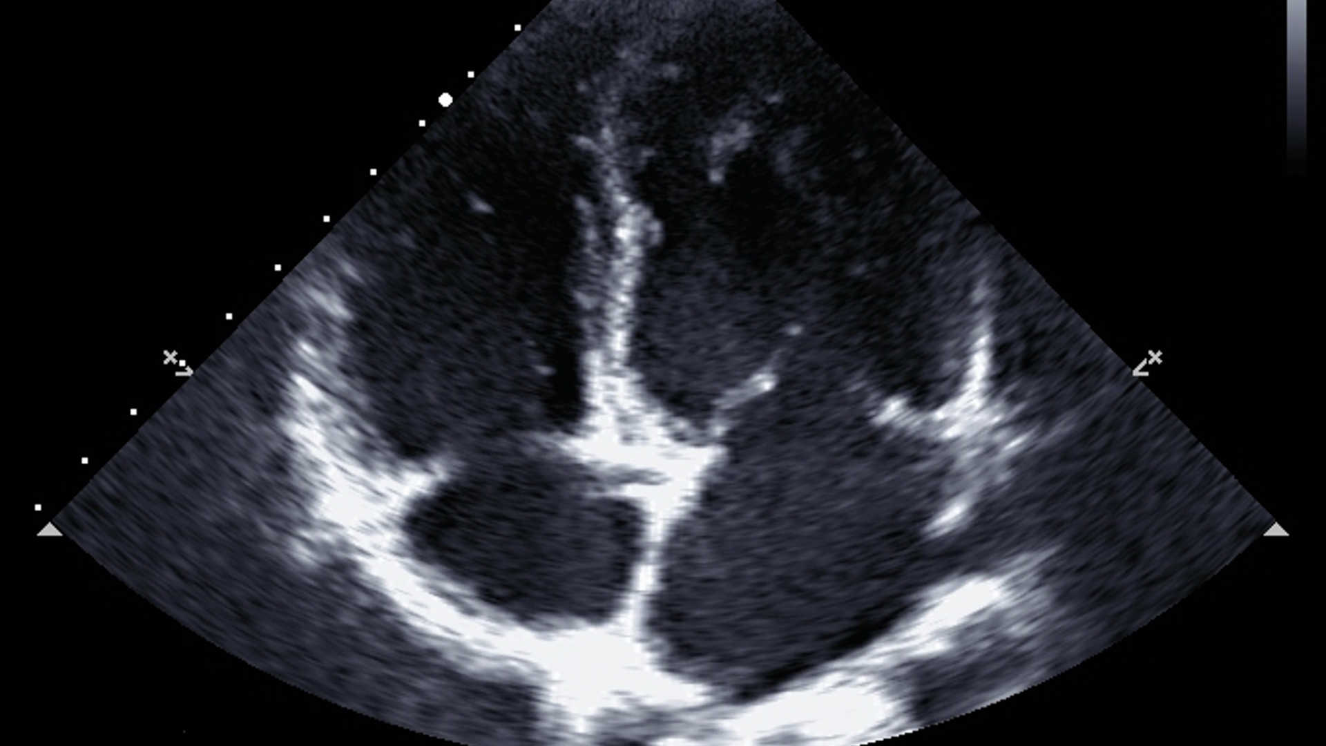 Apical 4 chamber echo view