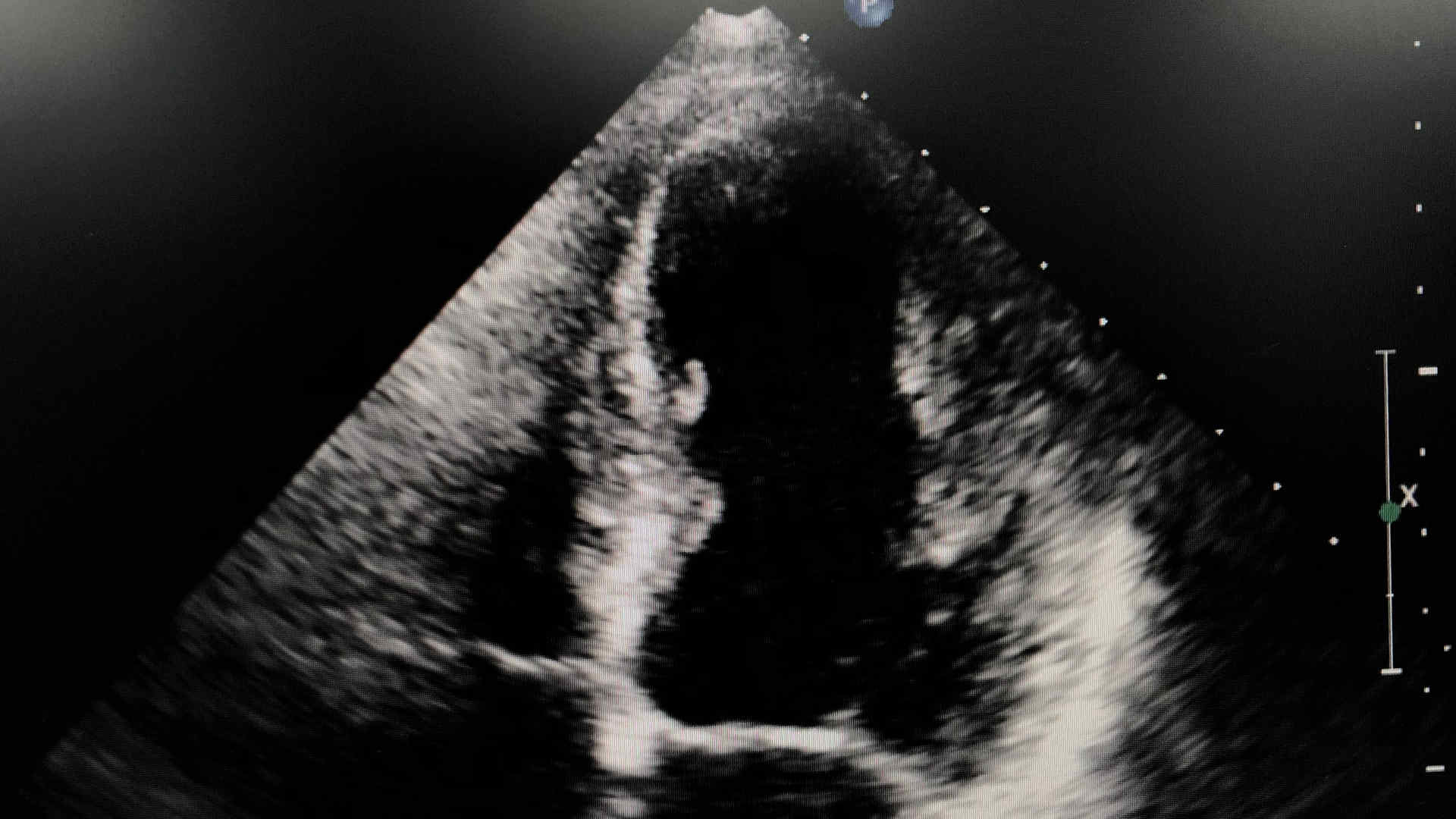 Echo of the left ventricle