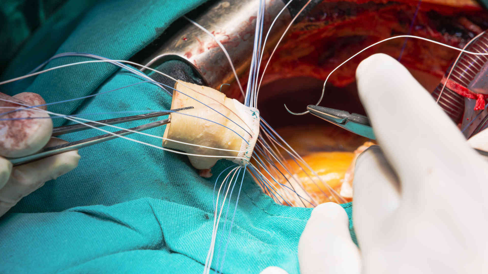 Heart valve replacement operation