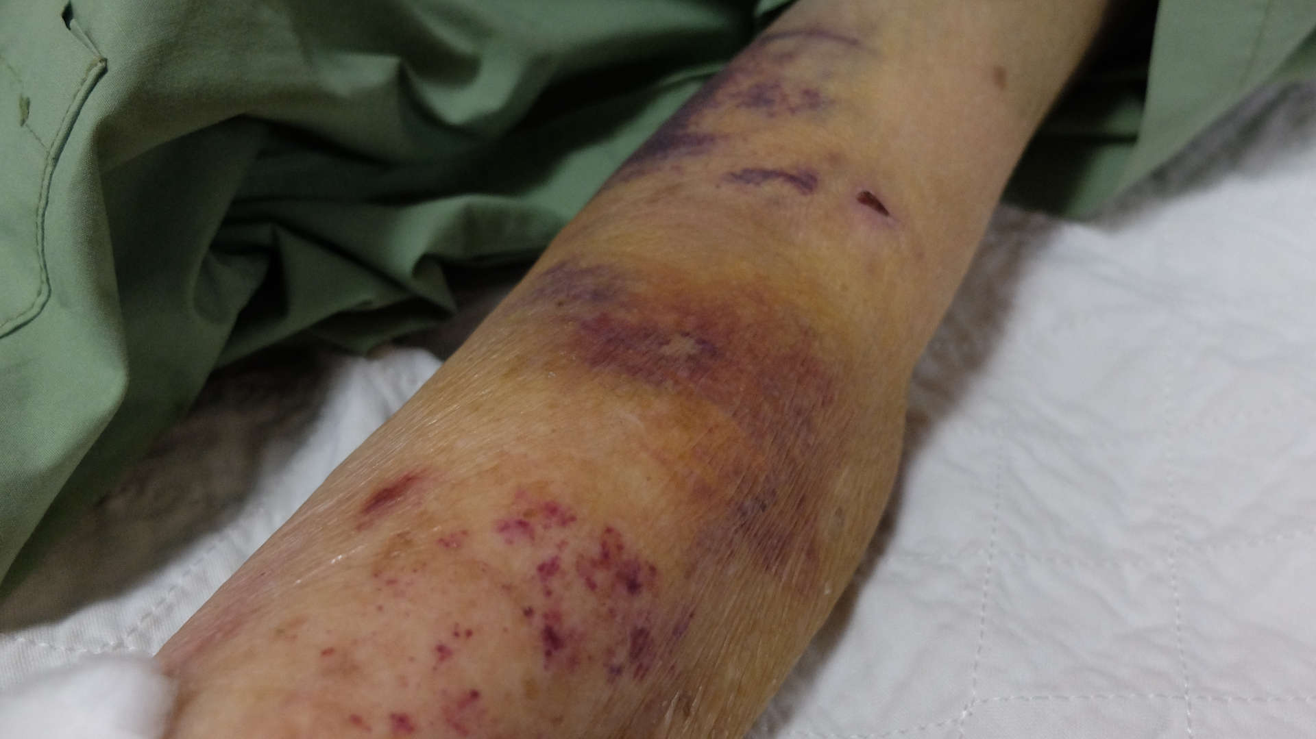 Leg showing bruises