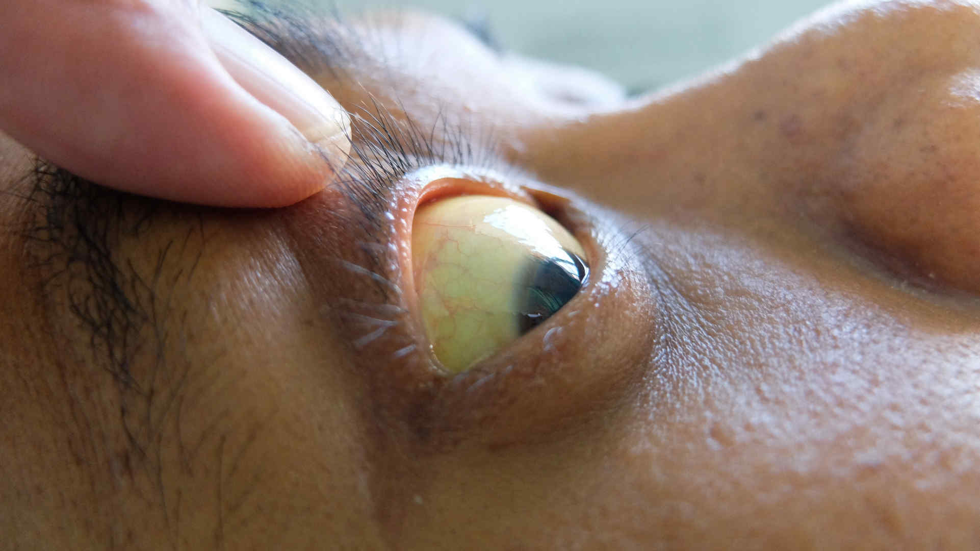 Scleral icterus