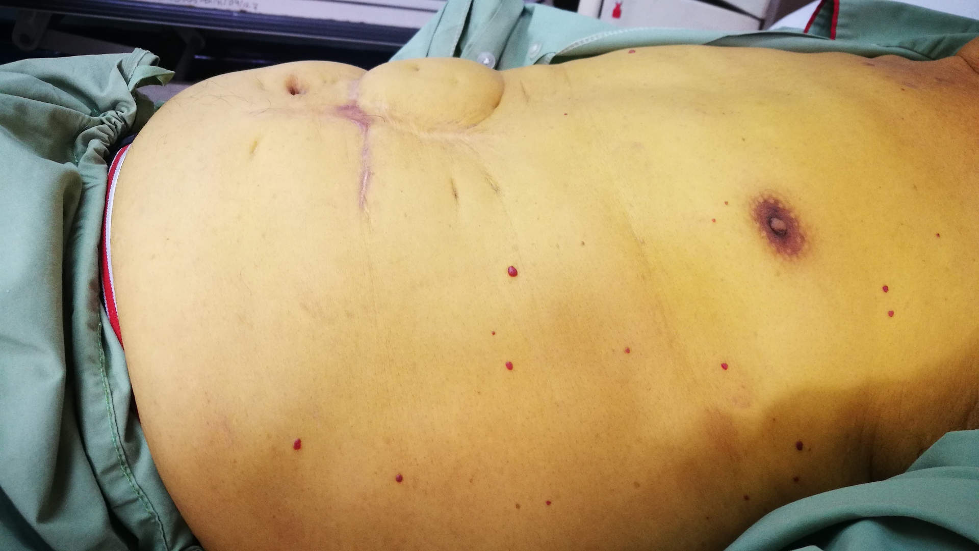 Jaundiced trunk of a patient in liver failure