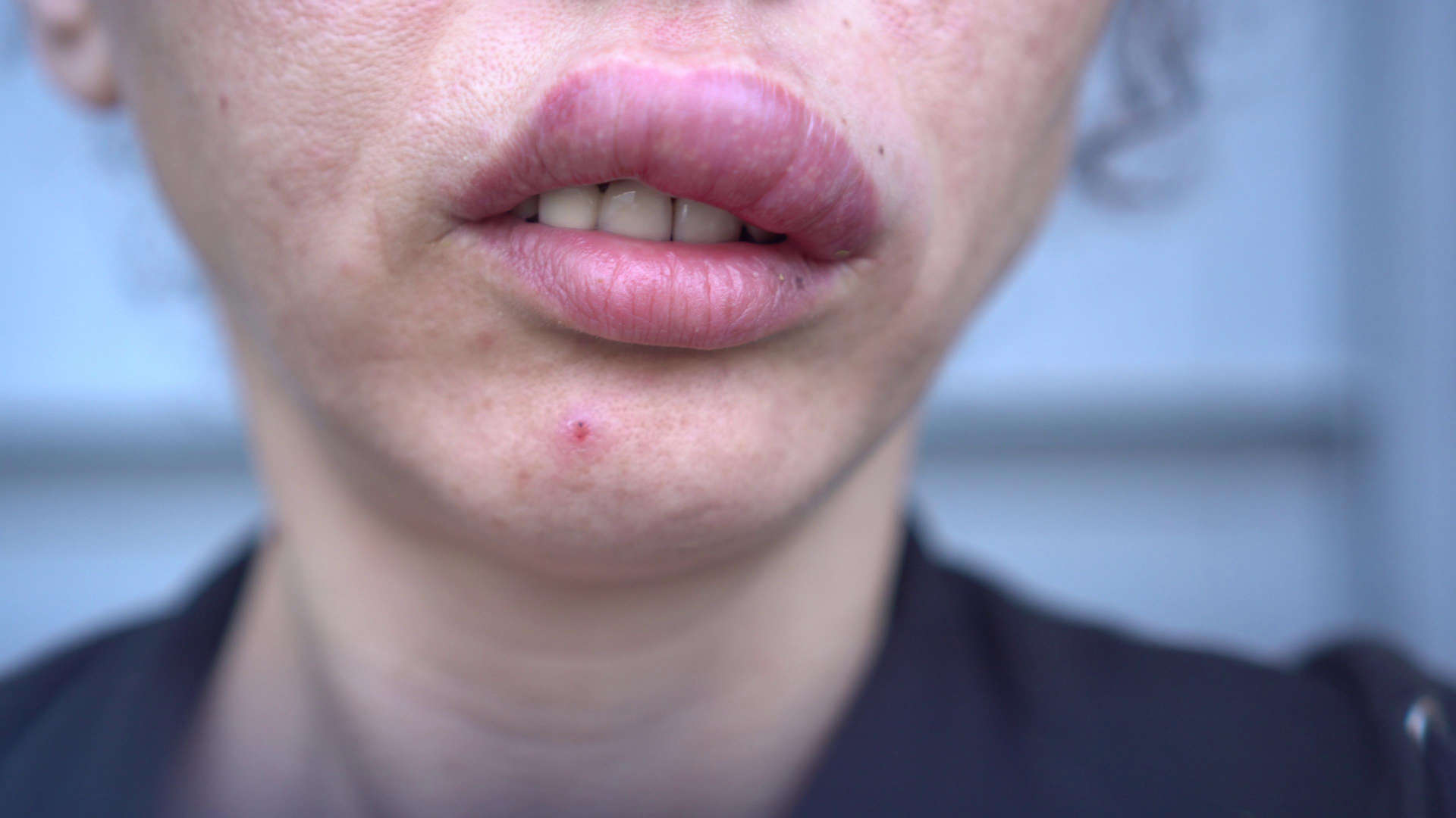 Swollen lip