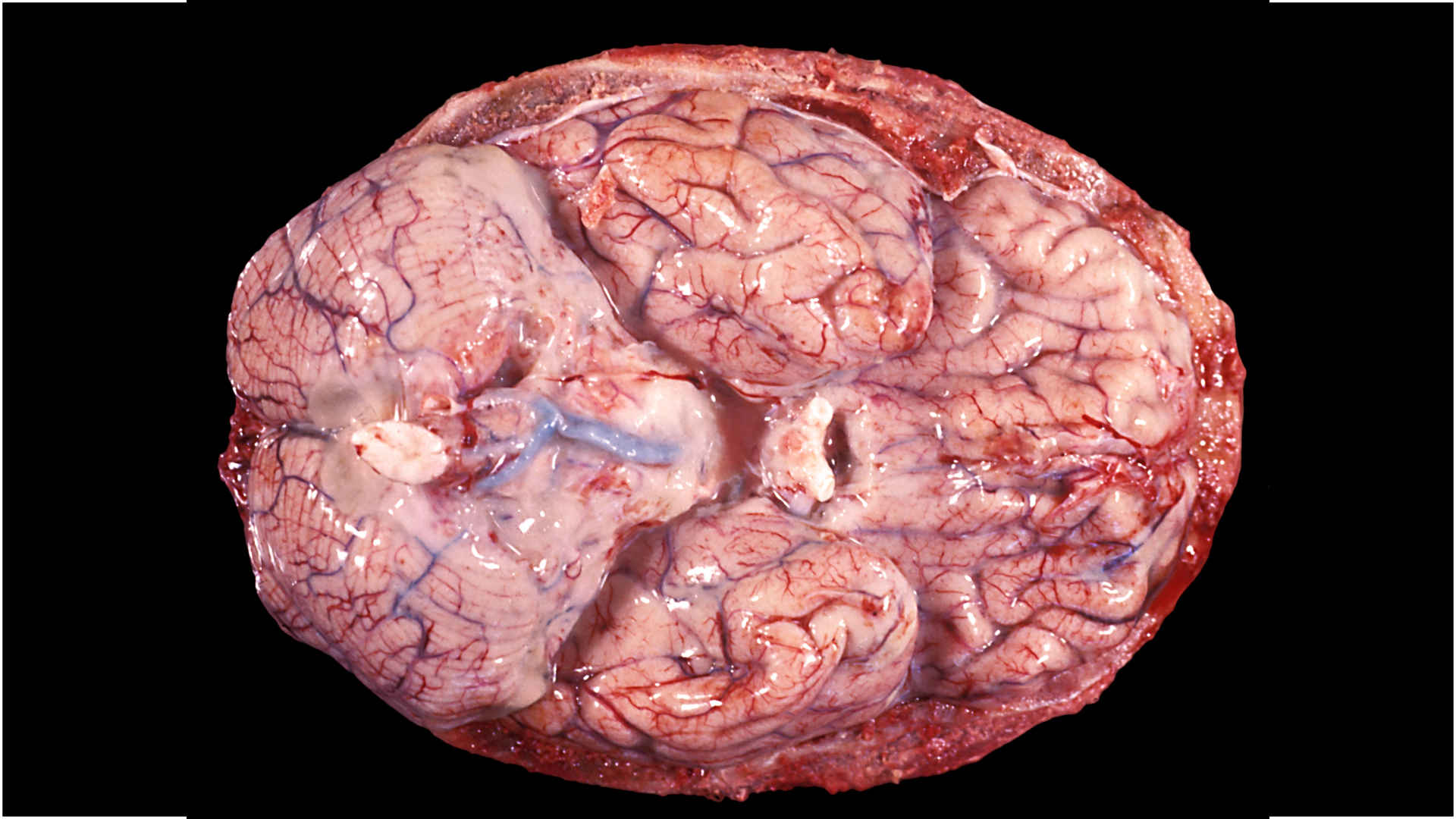 Pathological specimen showing basal meningitis