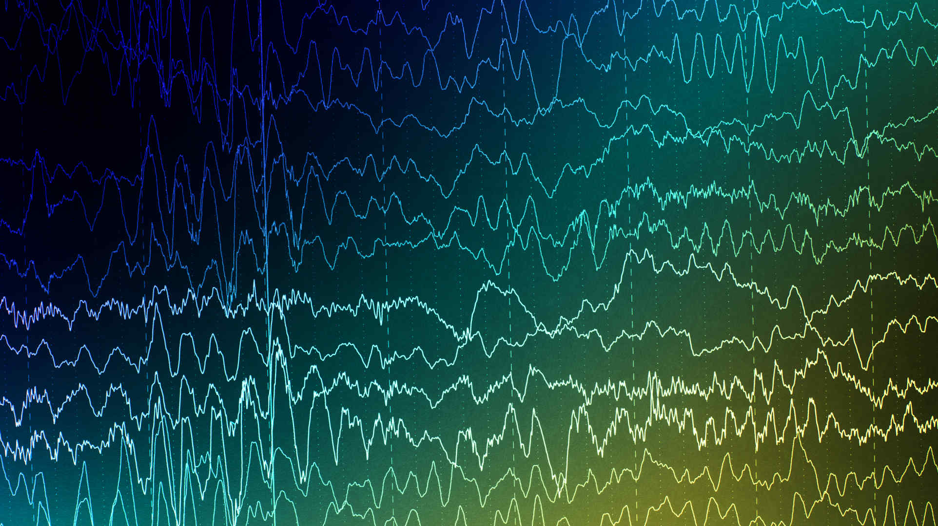 Lobar pneumonia on frontal chest radiograph