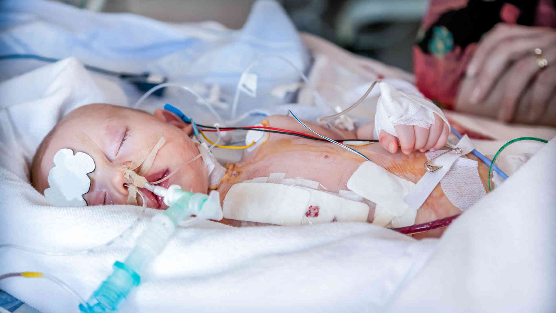 Intubated Infant in the ICU