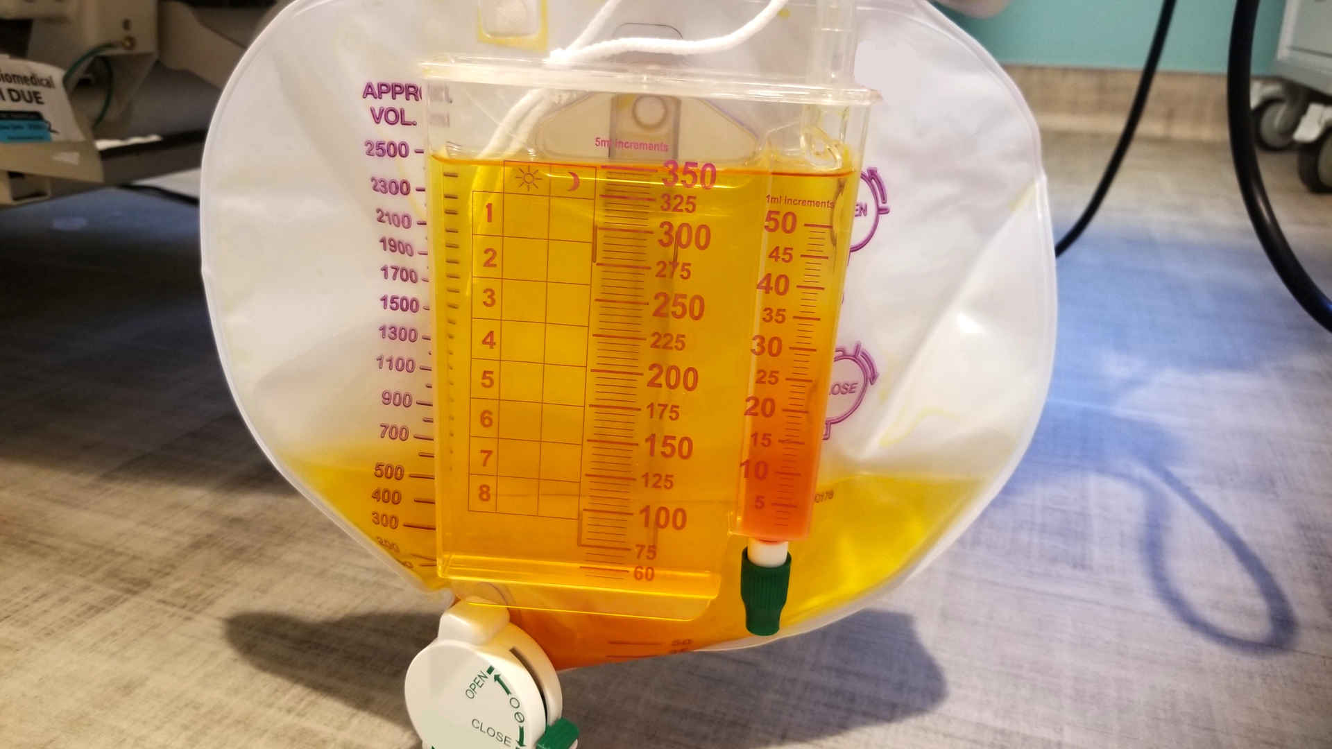 Urometer bag full of orange coloured urine
