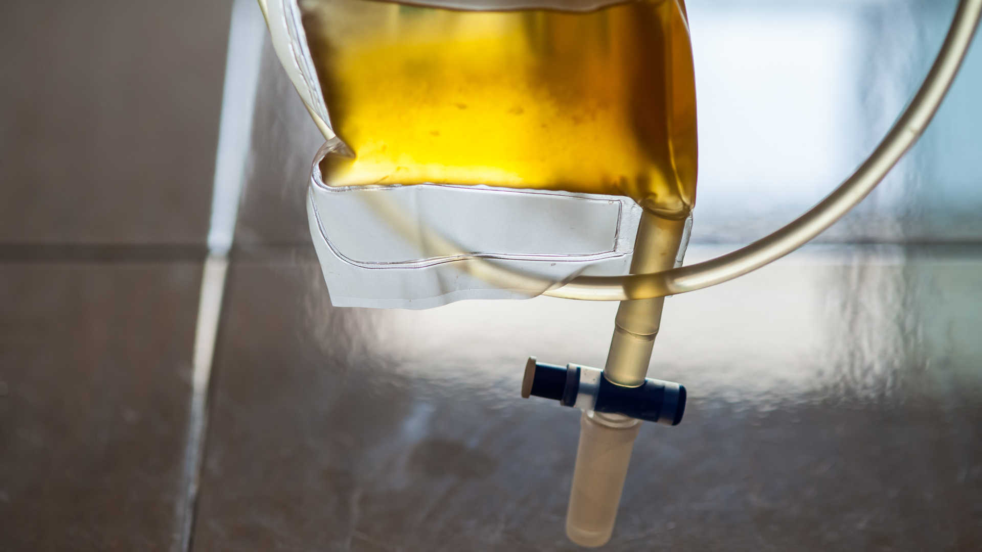 Urinary catheter bag containing yellow urine