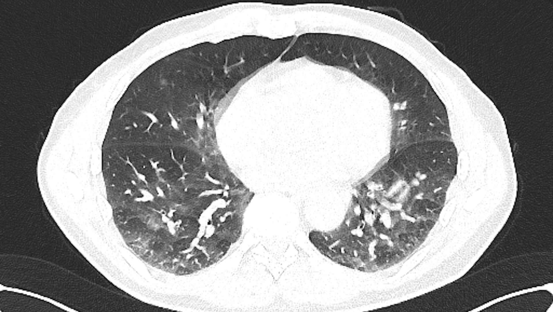CT lung scan consistent with ARDS