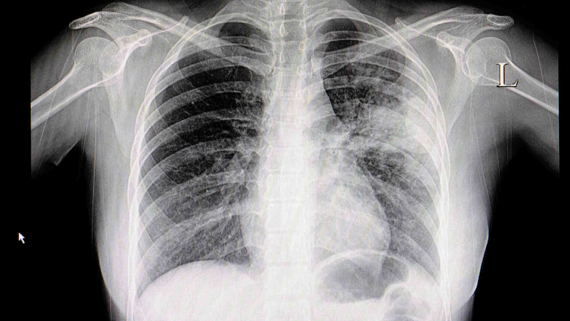 Lobar pneumonia on frontal chest radiograph