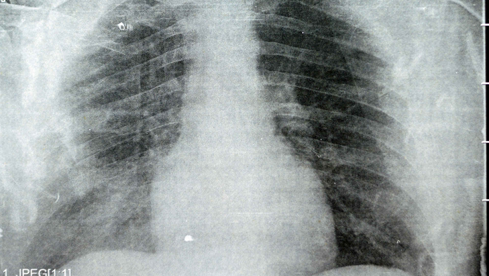 Chest radiograph showing aspiration