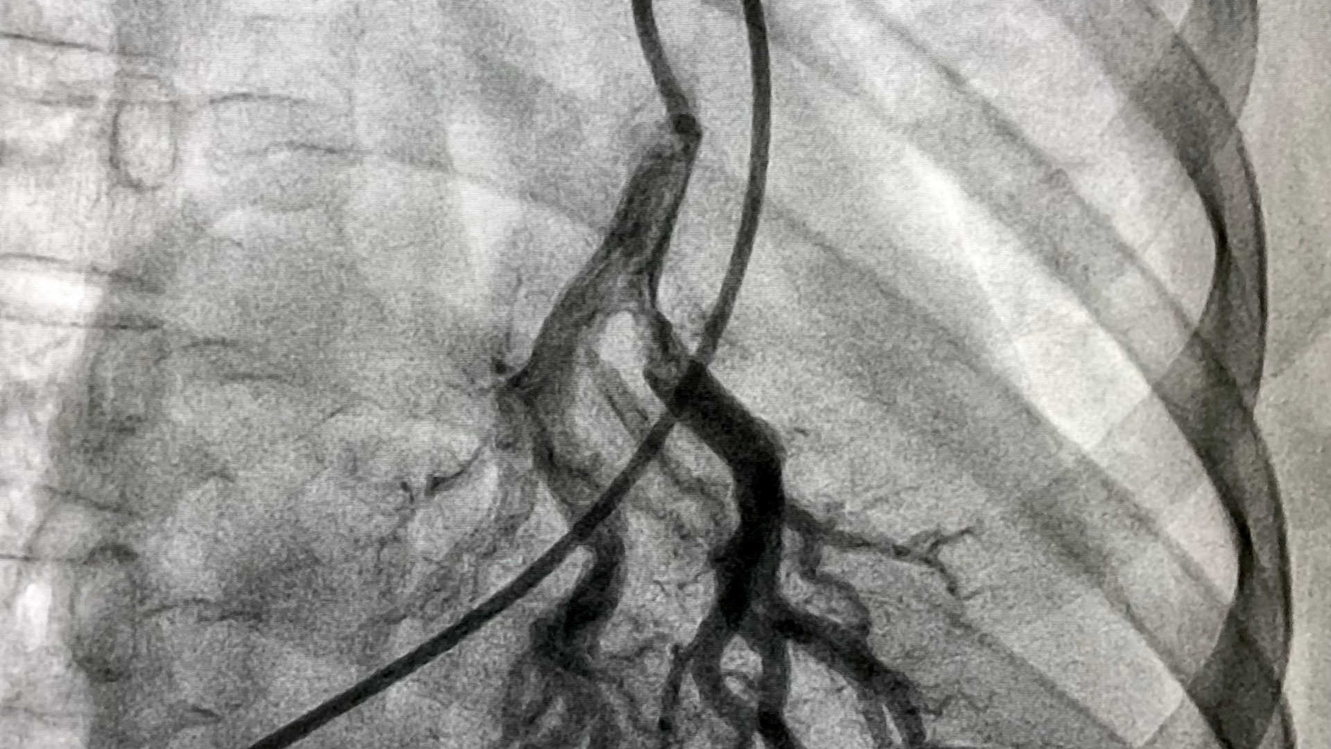 Pulmonary angiogram showing a pulmonary embolism