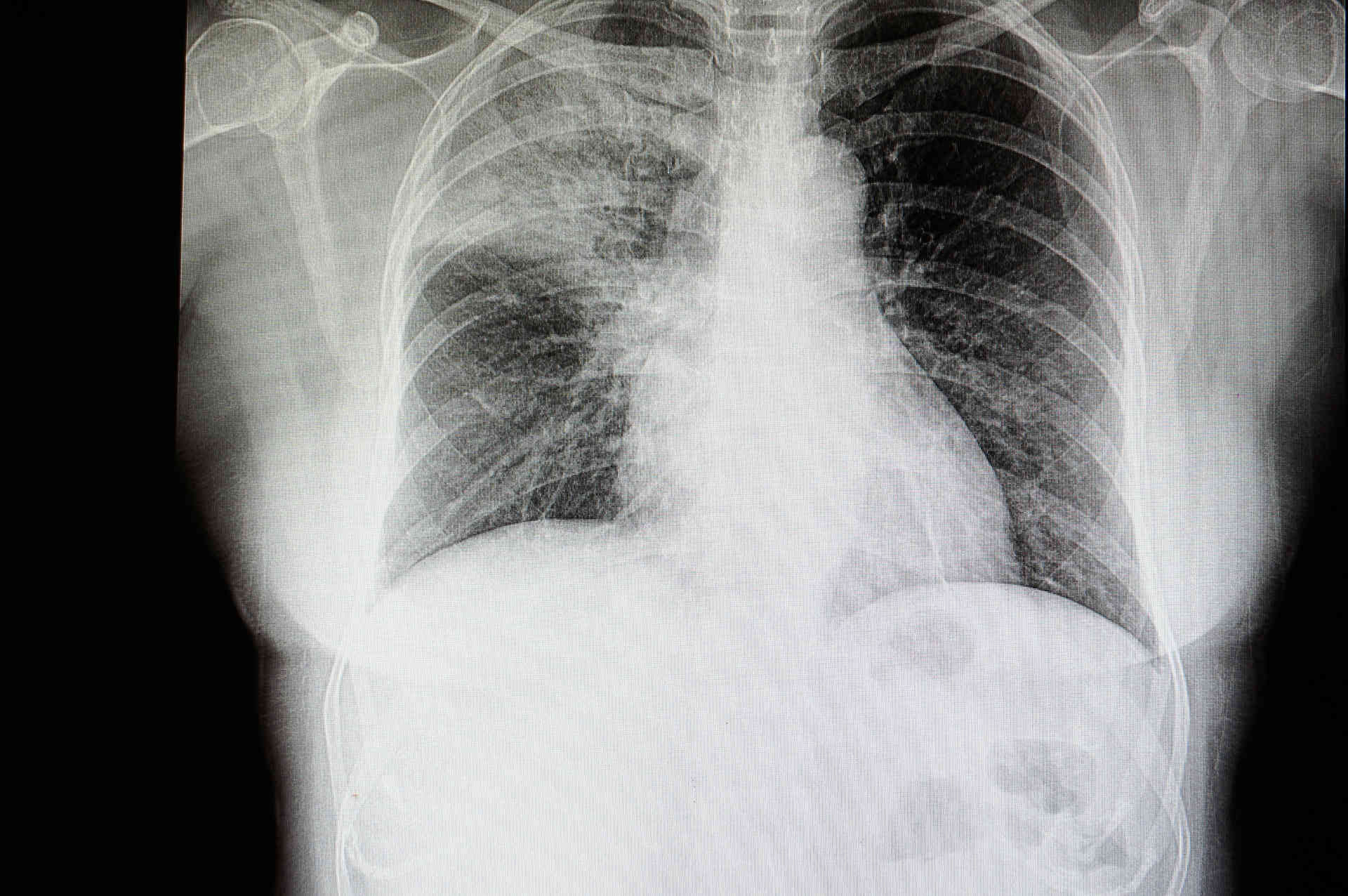Right upper lobe pneumonia on a frontal chest radiograph