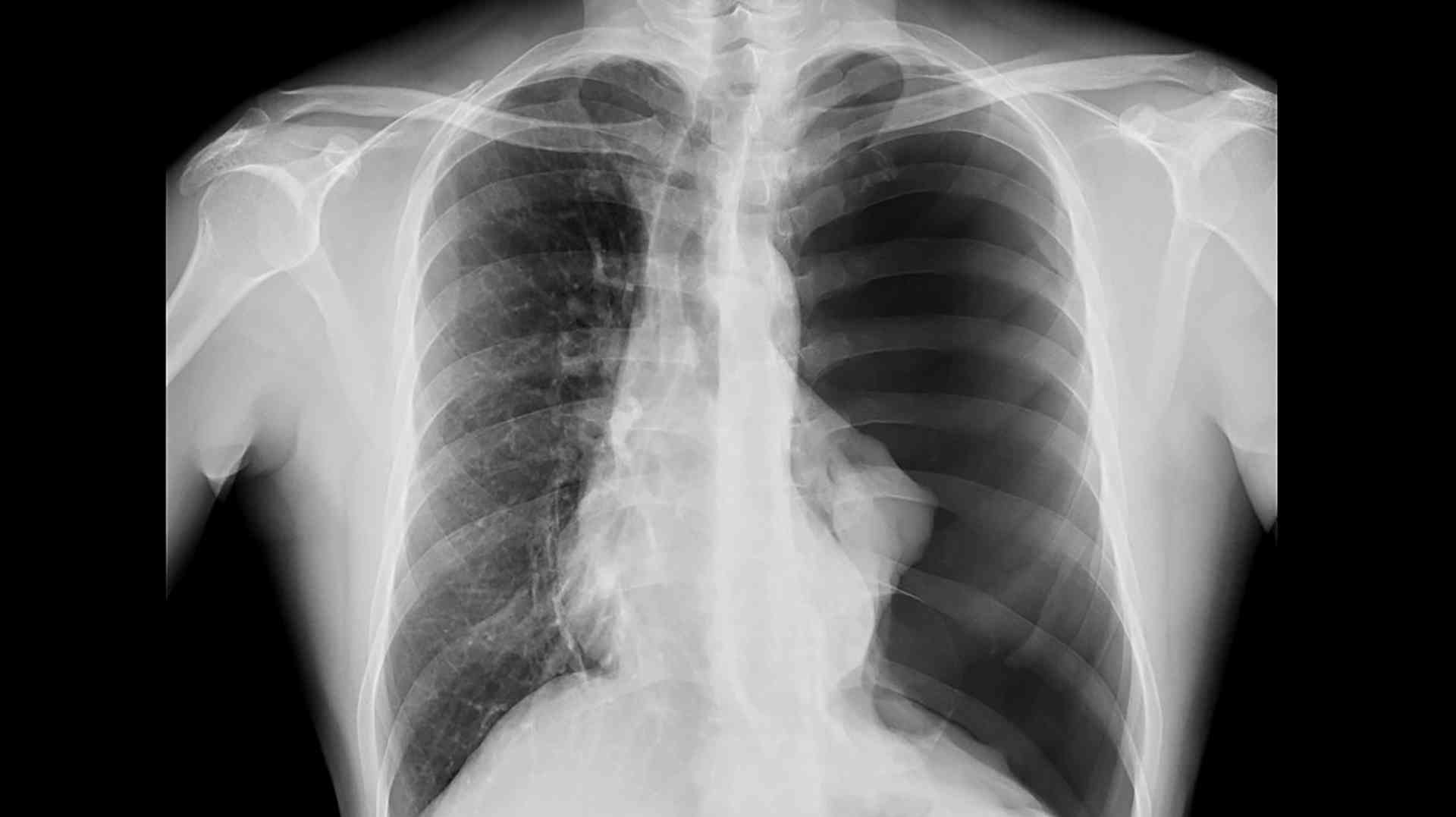 Pneumothorax on frontal chest radiograph