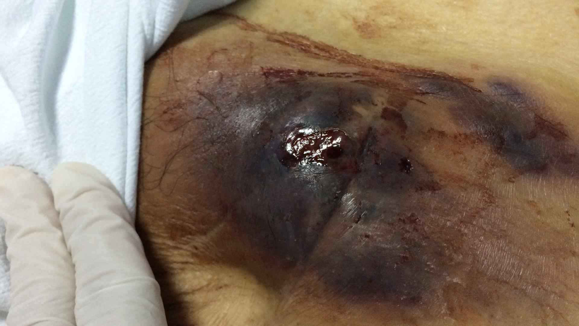 Infected haematoma