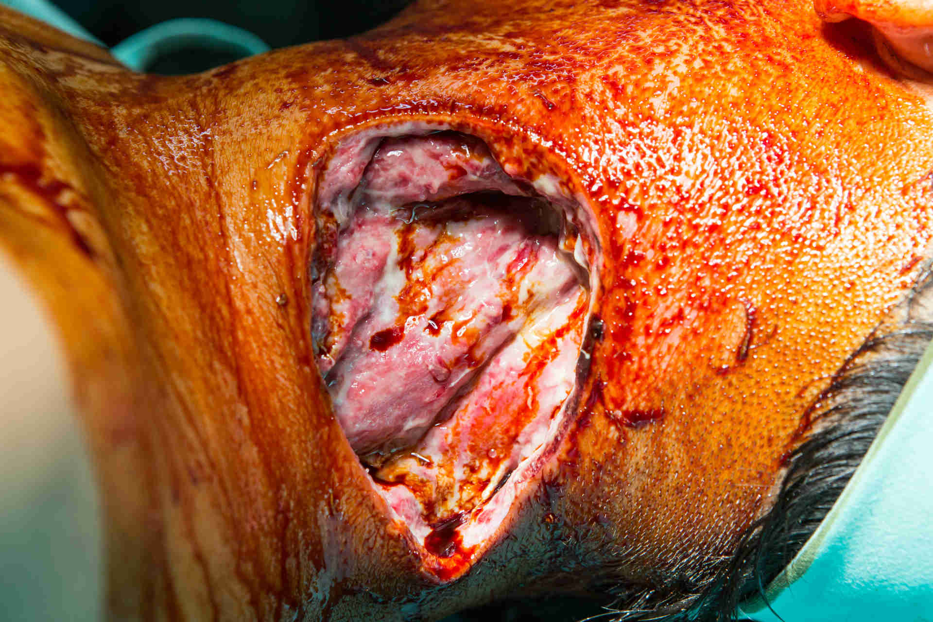 Large wound