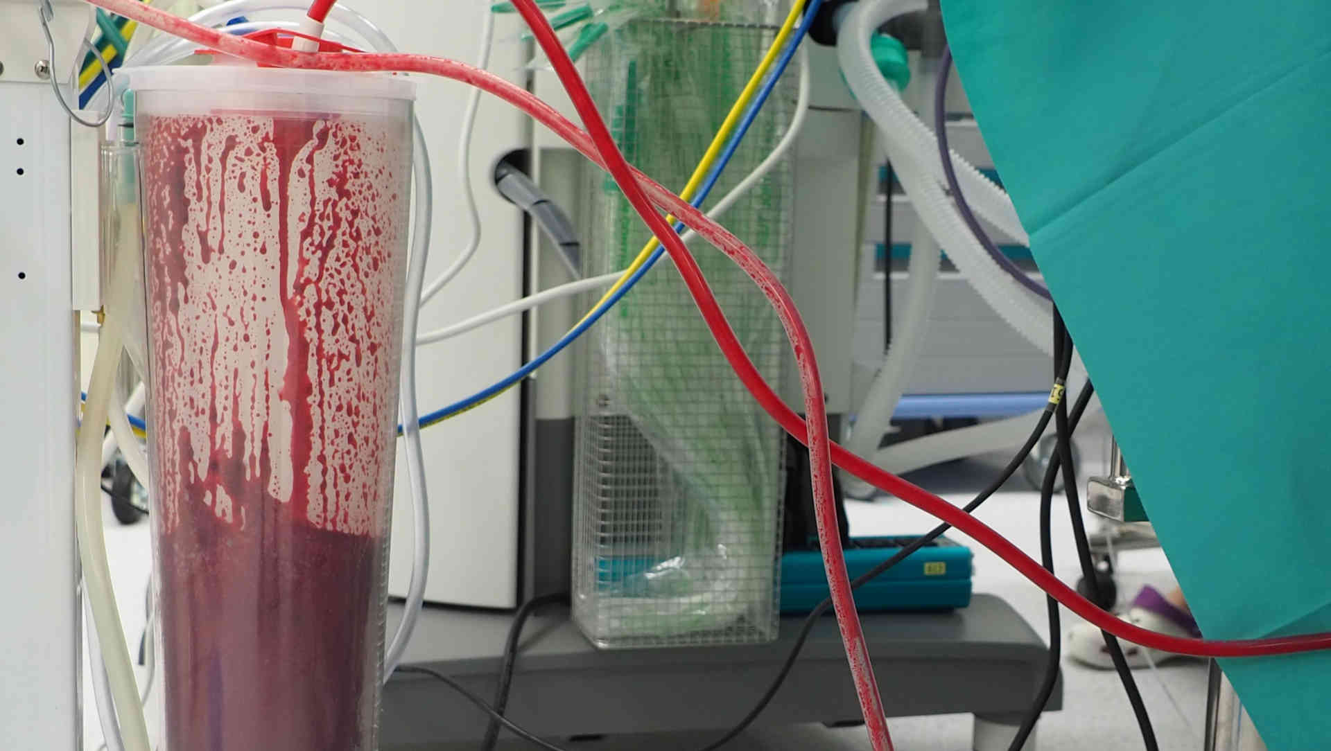Suction bottles full of blood in theatre