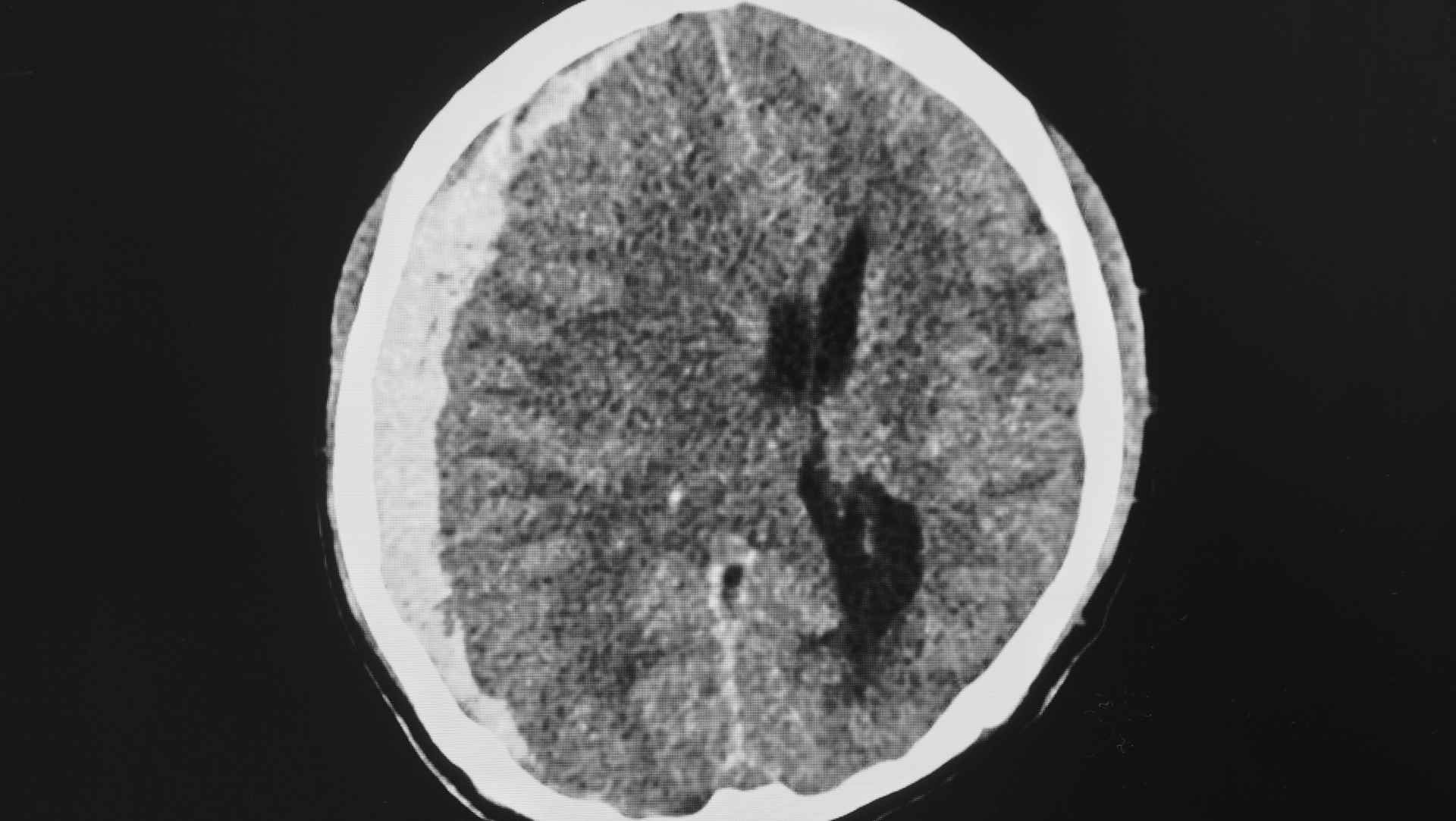 CT scan of a subdural haematoma