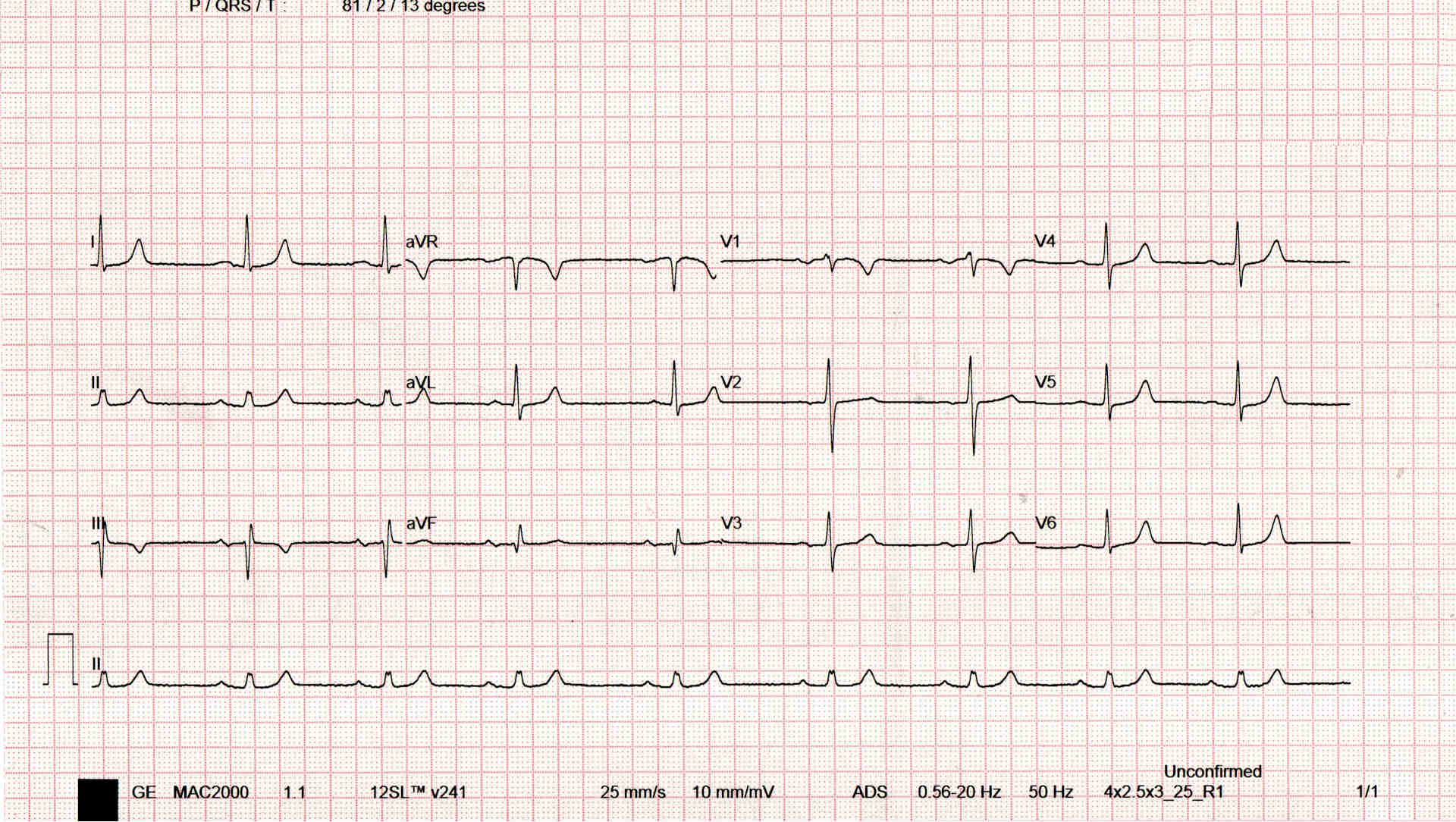 Sinus Bradycardia ECG