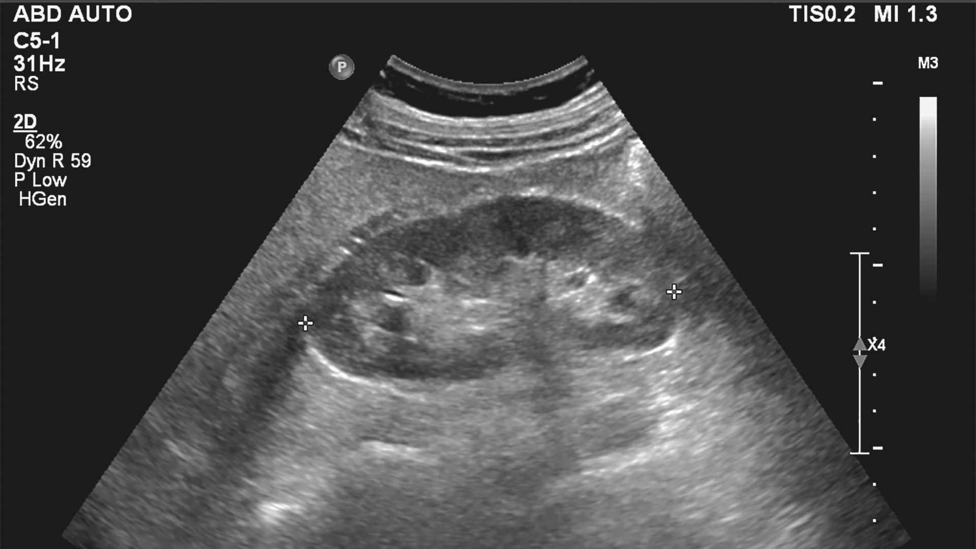 Ultrasound image of a kidney