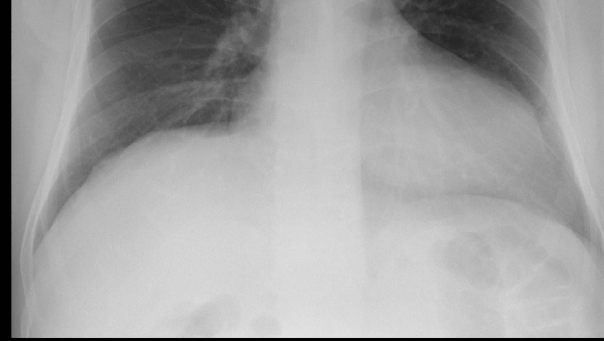 Left lower lobe collapse