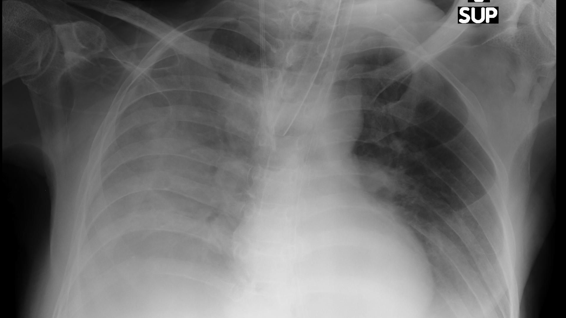 Sinus Bradycardia ECG