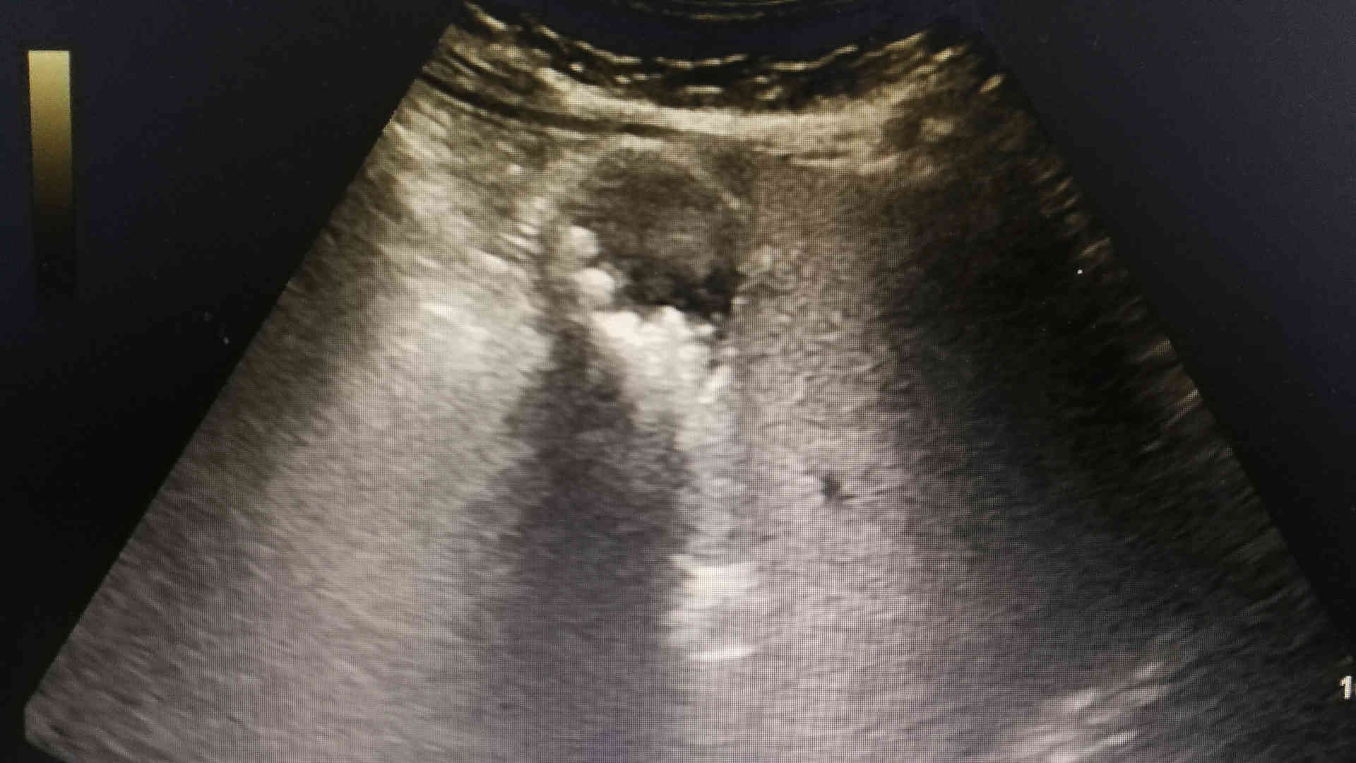 Ultrasound of gallstone-related cholecystitis