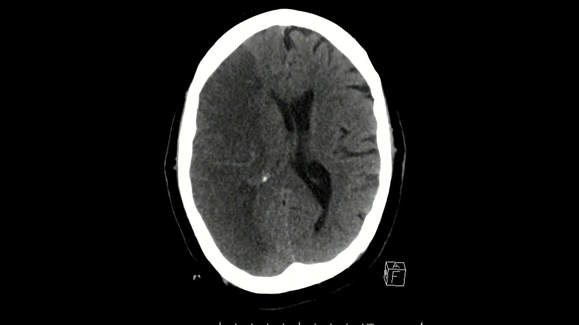 Cerebral infarction