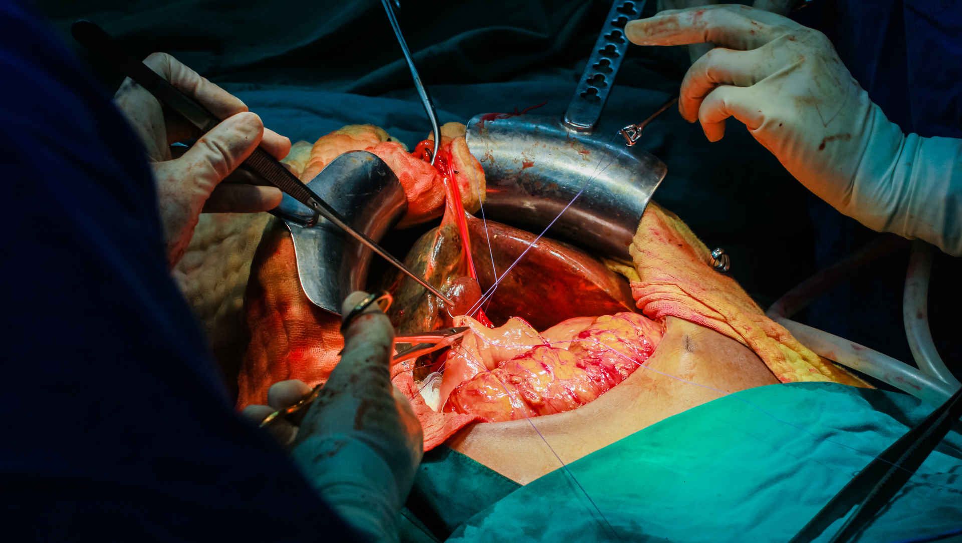 Operation of liver transplantation