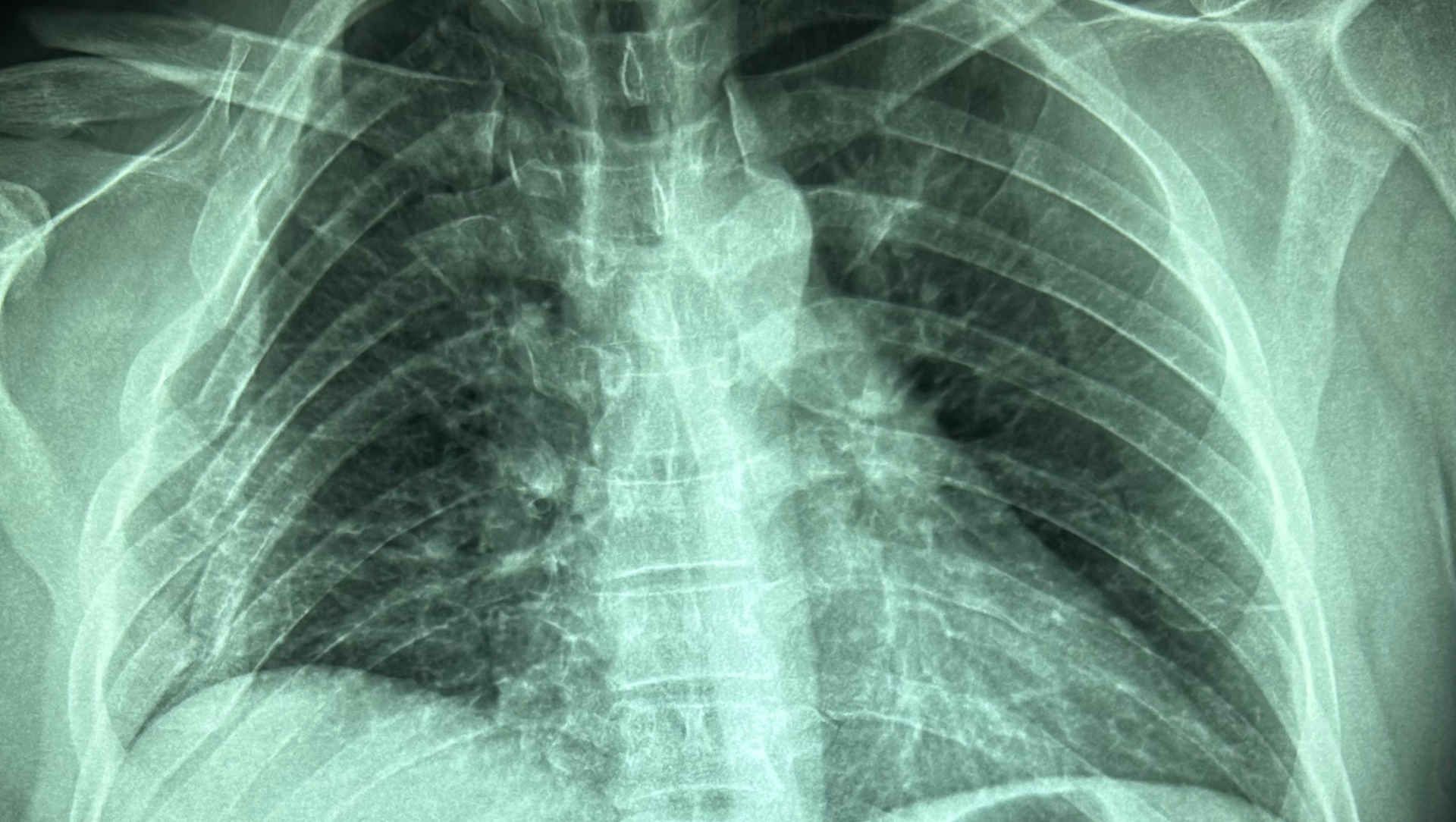 chest radiograph rib fractures
