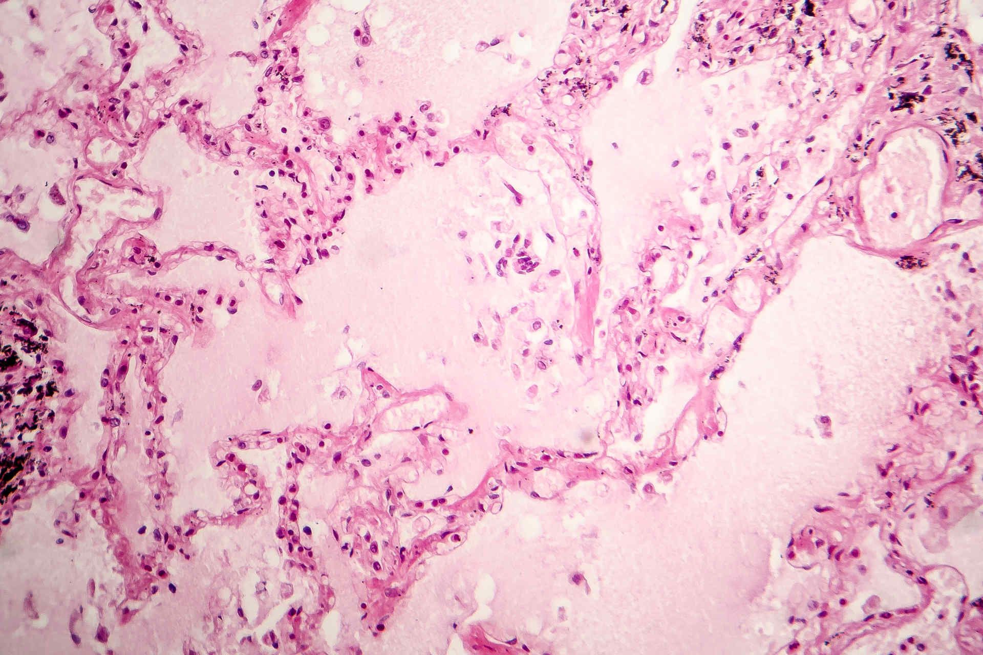 Cardiogenic pulmonary oedema histology slide