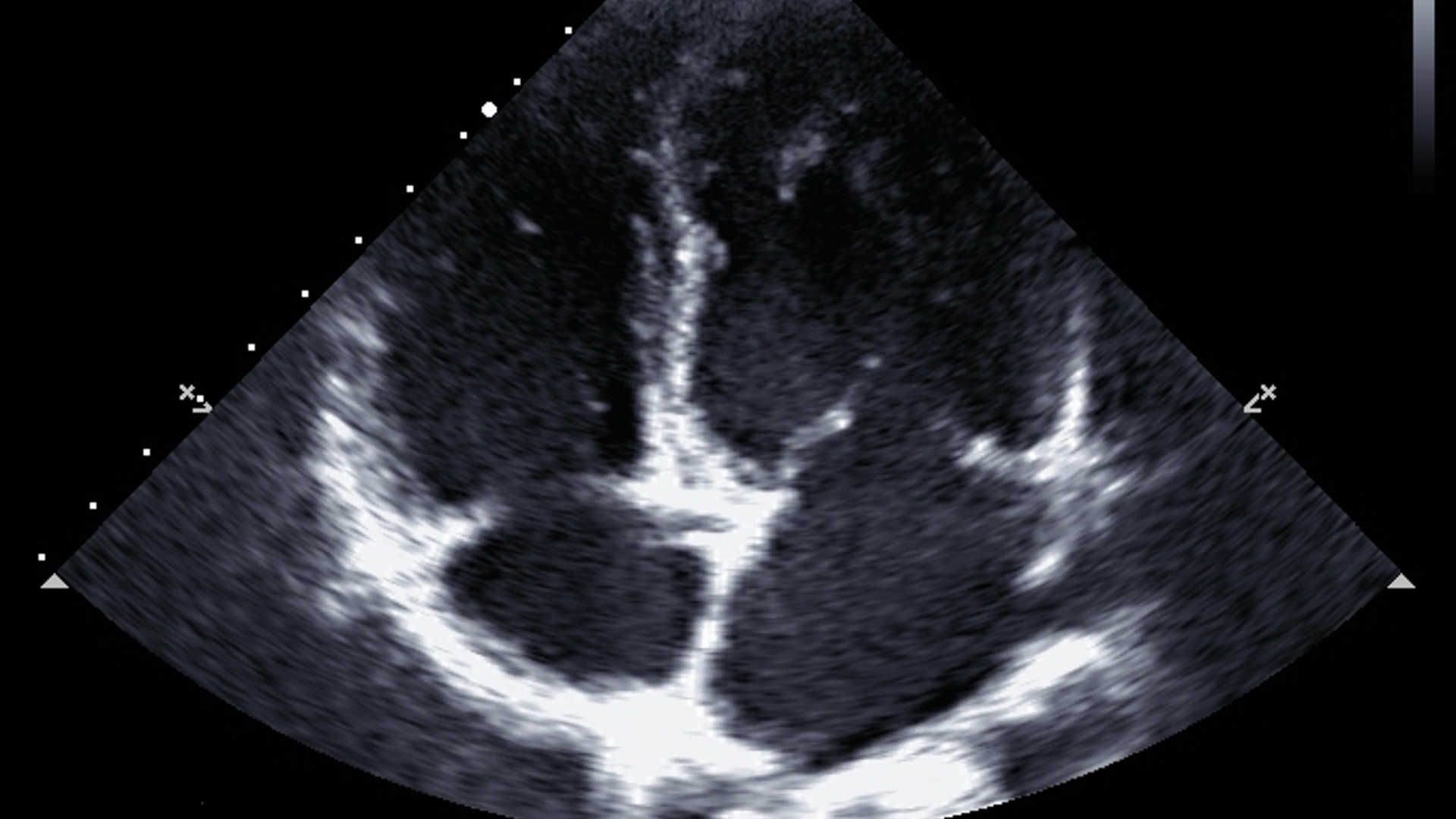 4 chamber echo image